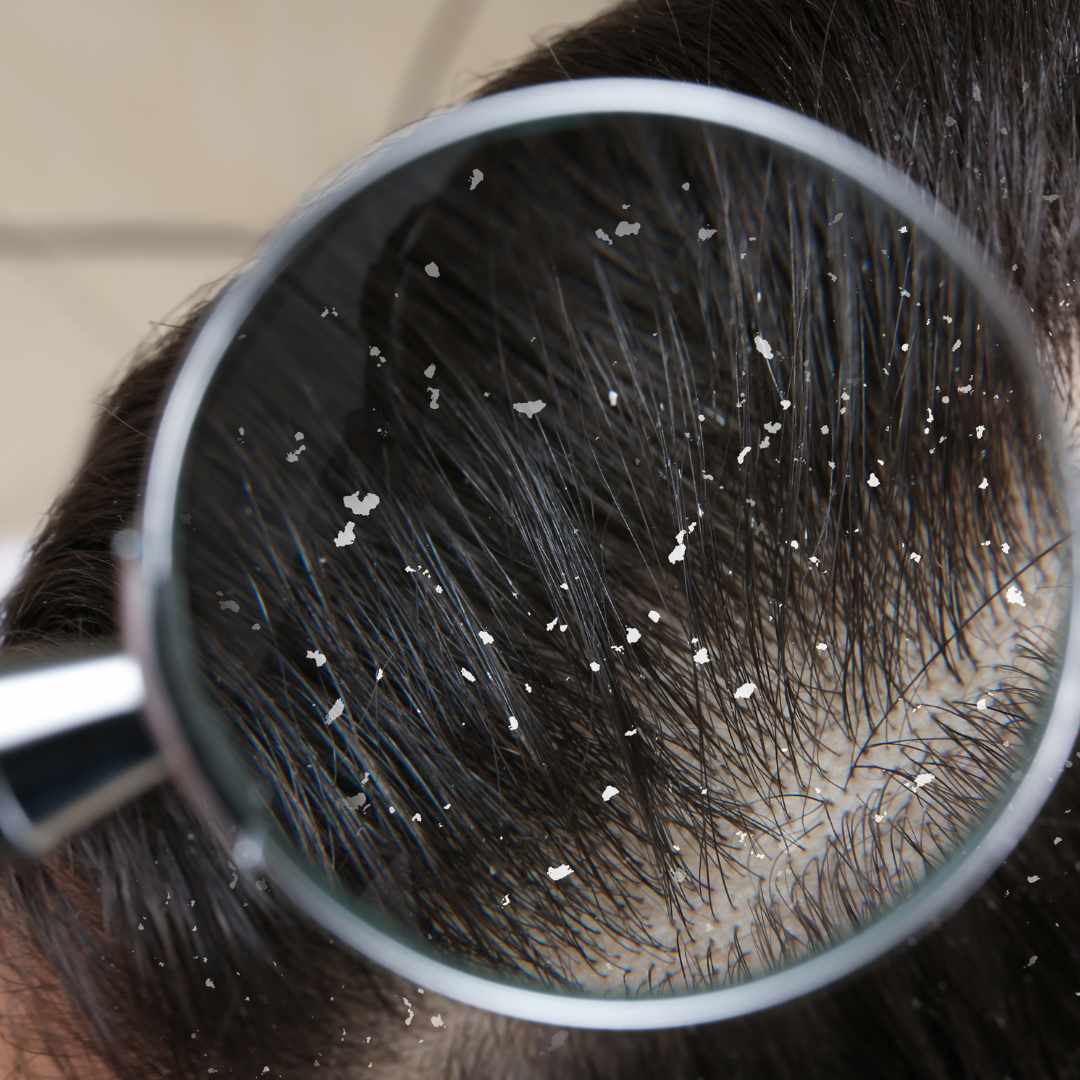 Shampoo til tør hovedbund